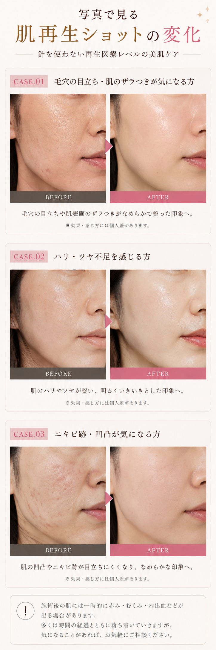 肌再生ショット施術例。毛穴・ざらつき、ハリ・ツヤ不足、ニキビ跡・凹凸のCASE.01〜03 Before・After比較